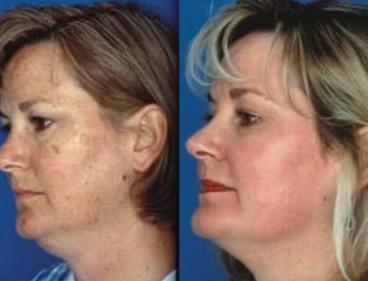 50% off Chemical Peel Special