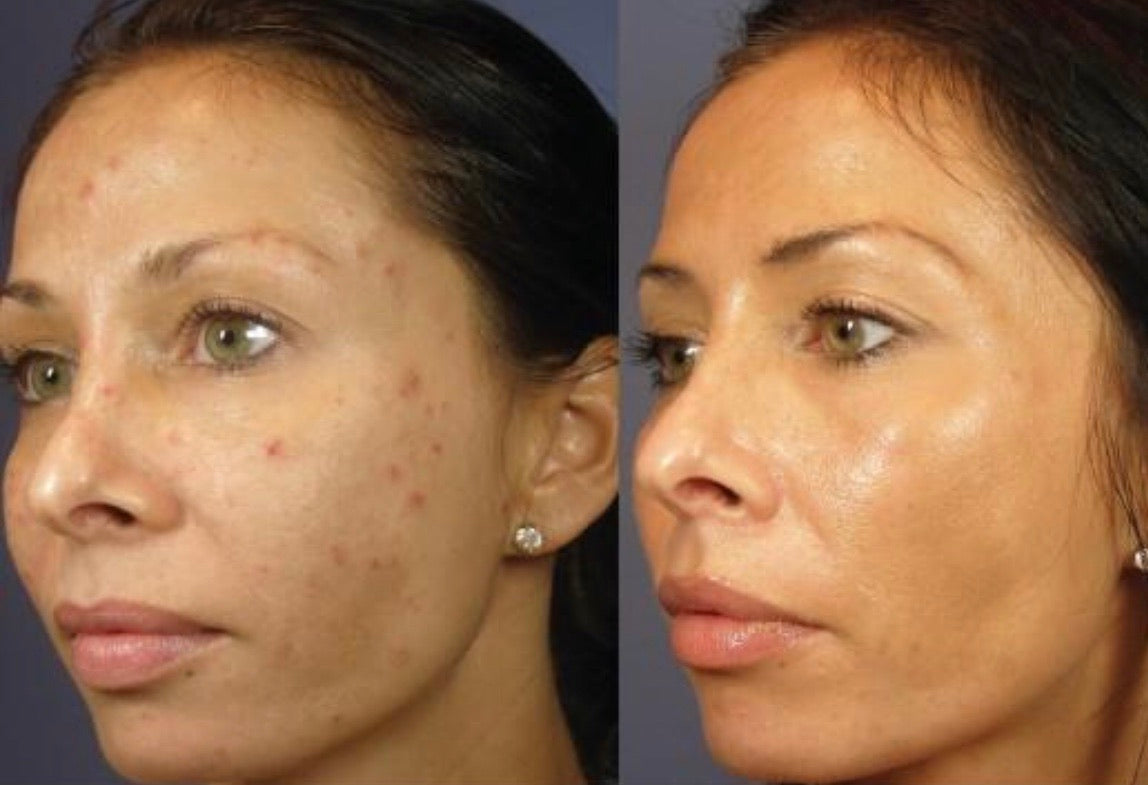 50% off Chemical Peel Special